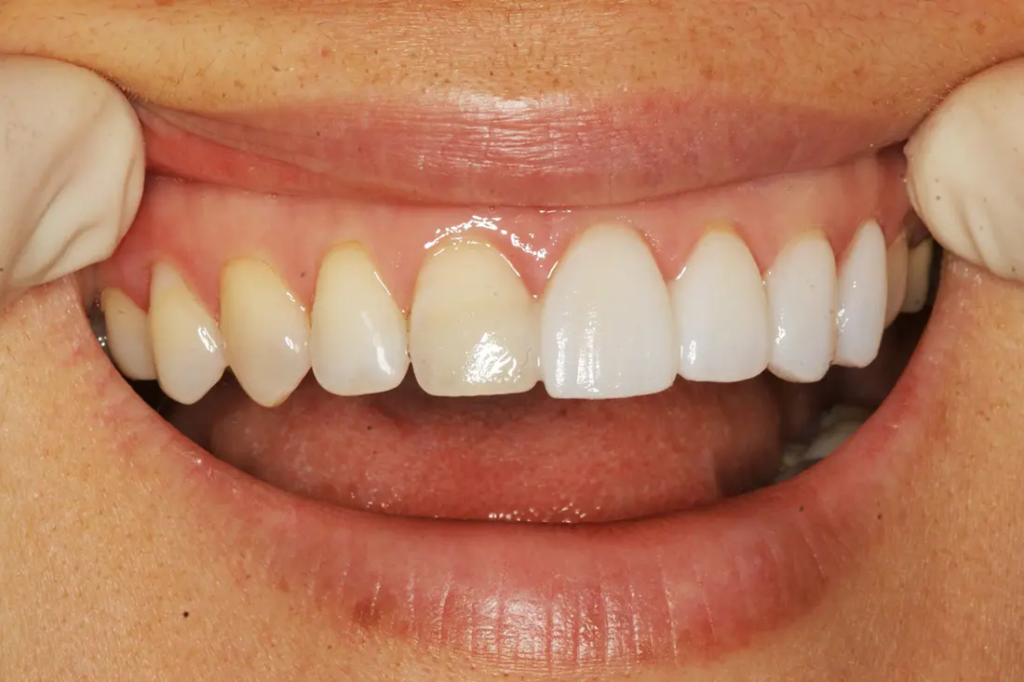 cosmetic dentist for your veneers in Agoura Hills