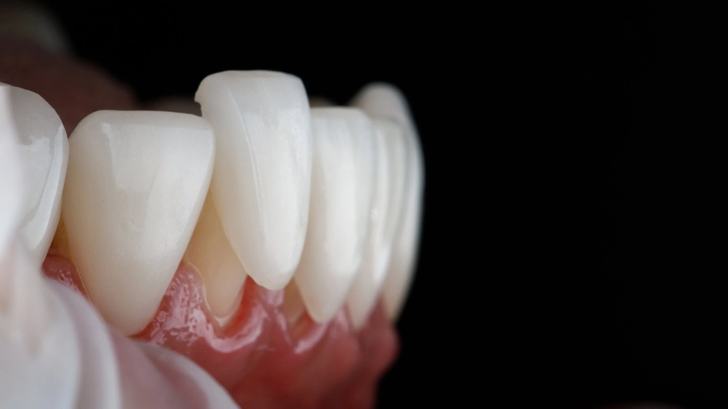 Veneers Dentist Near You