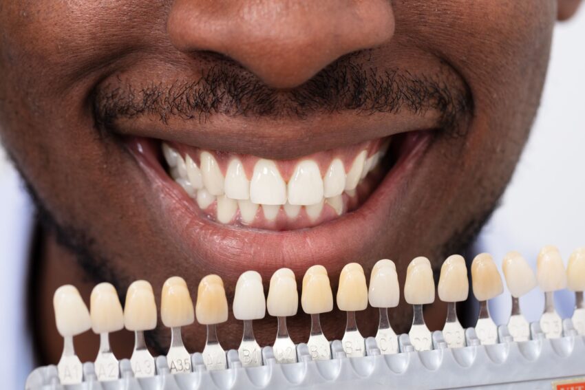 dental_veneers_vs_crowns